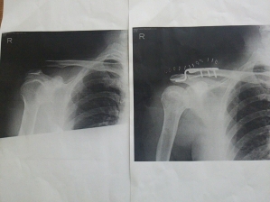 肩の手術